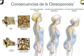 Osteoporosis, porqué se produce